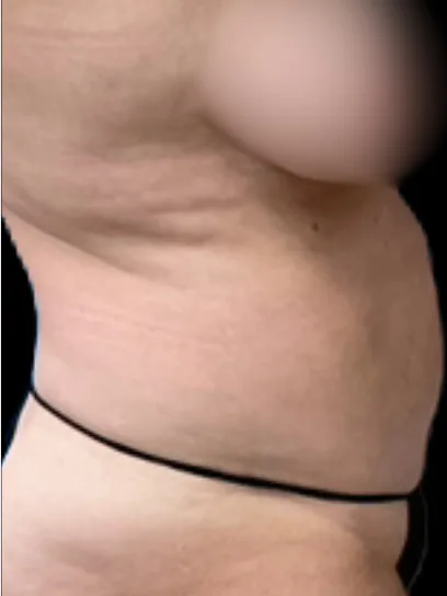 Tummy Tuck, view 1 before