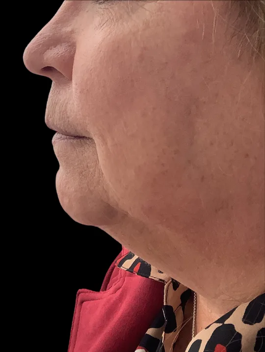 Neck Lift, view 1 before