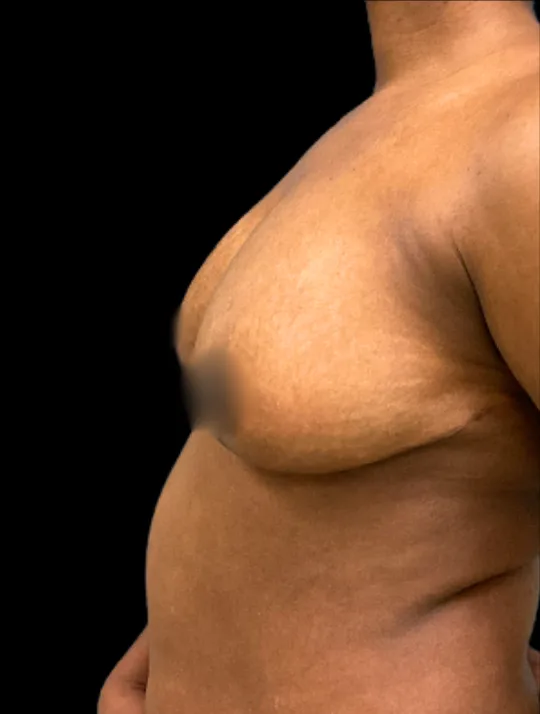 Breast Reduction, view 1 after