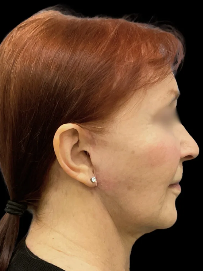 Facelift, view 2 after