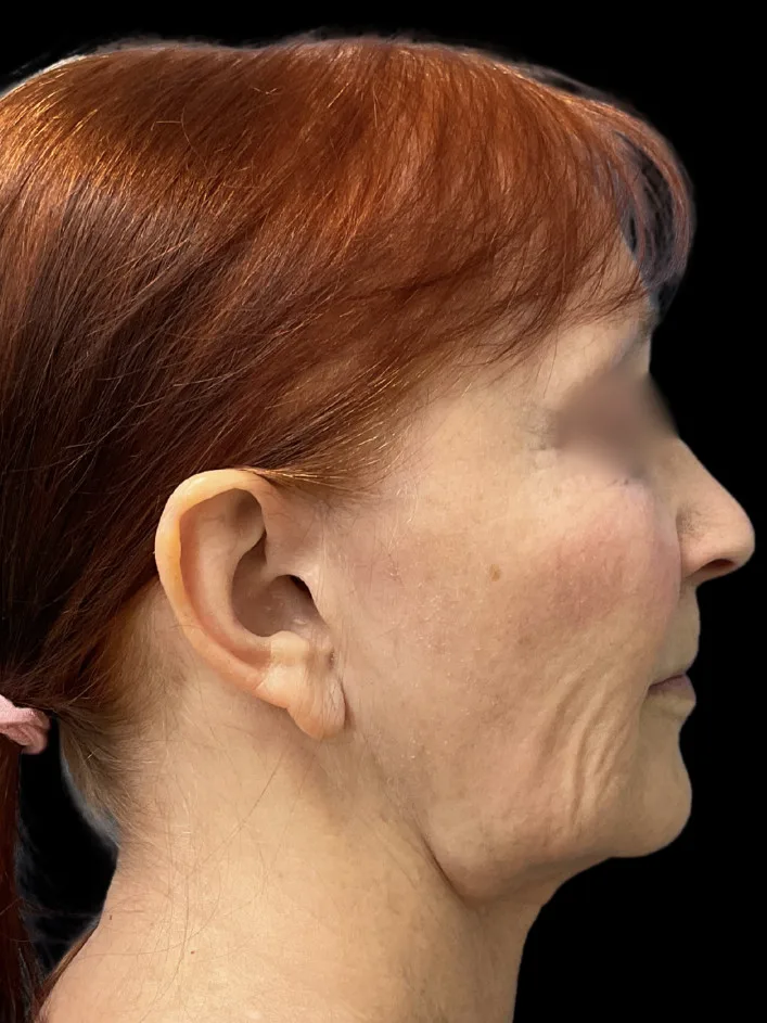 Facelift, view 2 before