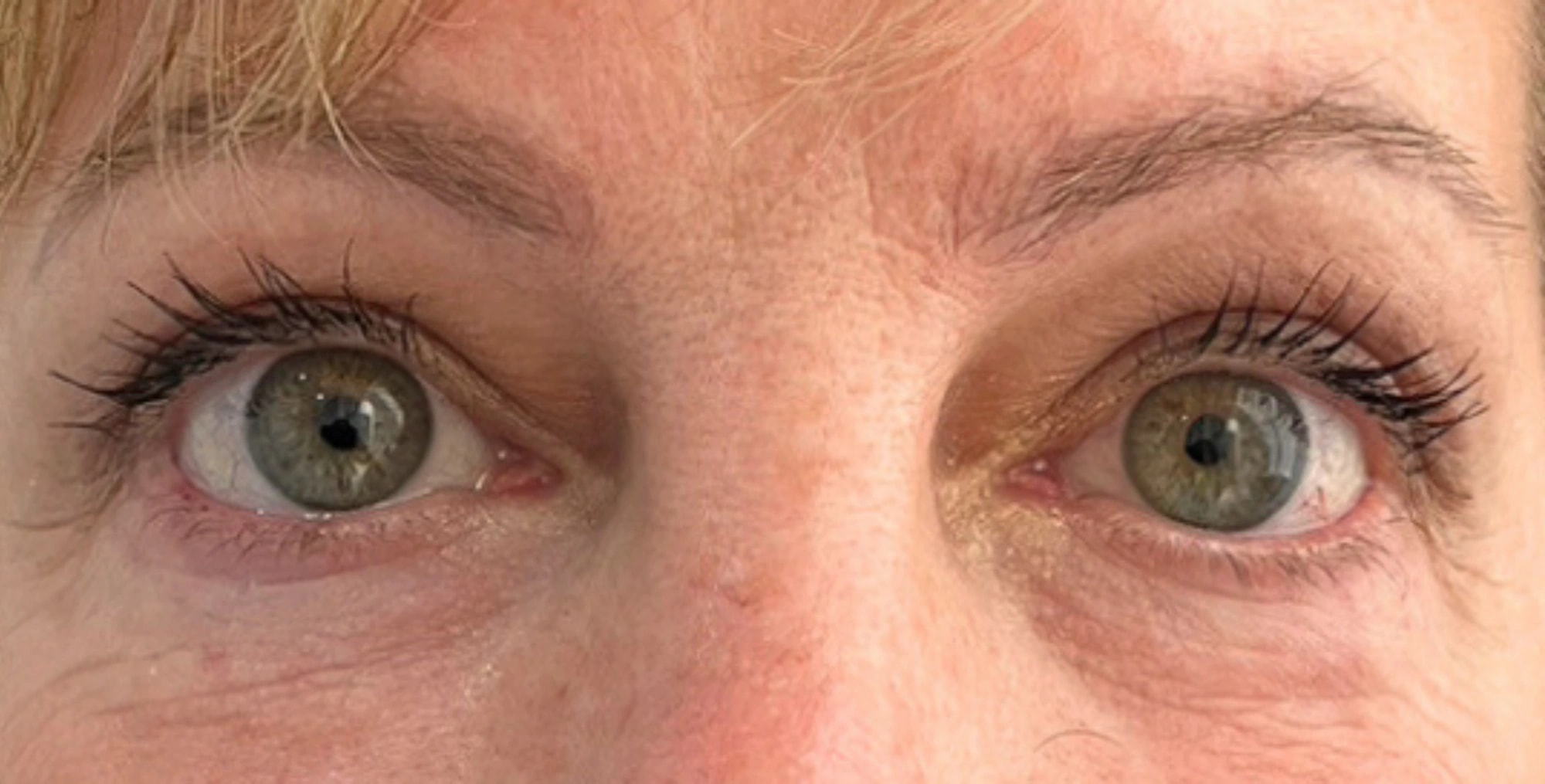 Eyelid Surgery, view 1 after