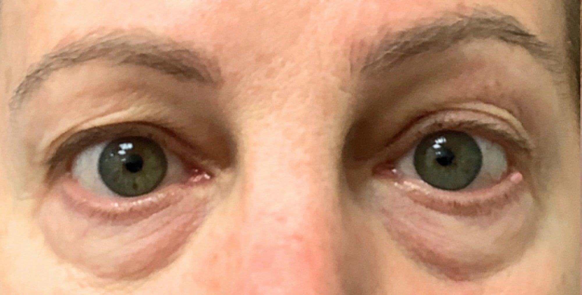 Eyelid Surgery, view 1 before