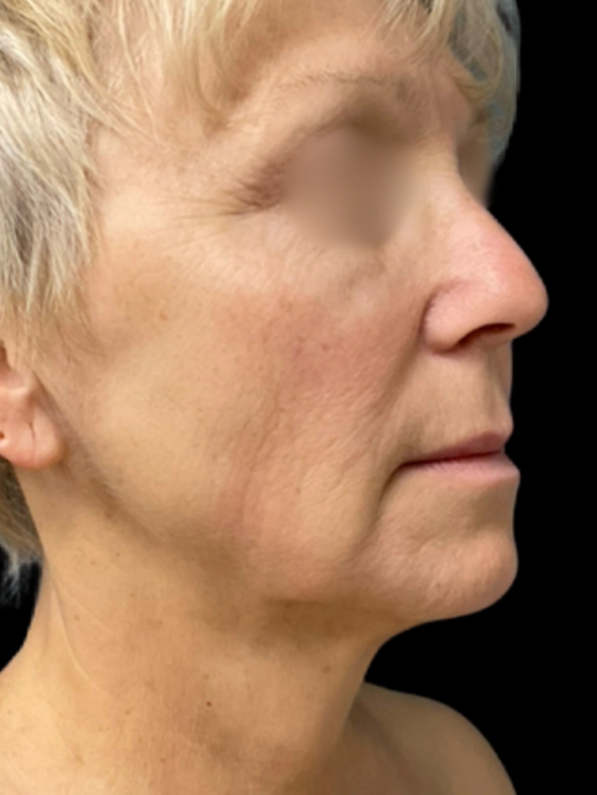 Neck Lift, view 1 before