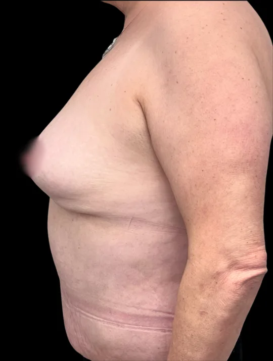 Tummy Tuck, view 1 after