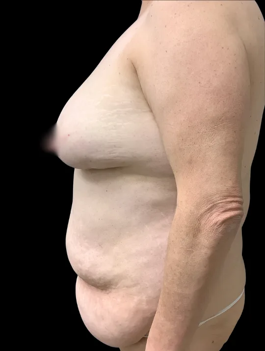 Tummy Tuck, view 1 before