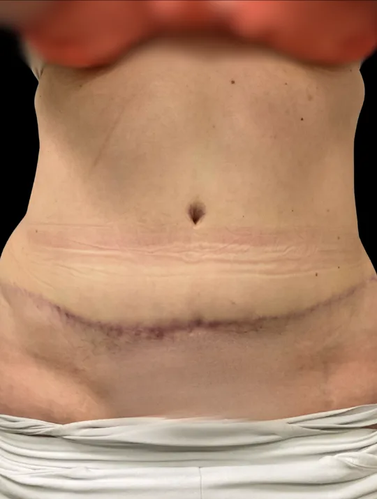 Tummy Tuck, view 3 after
