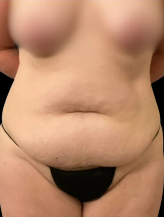 Tummy Tuck, view 3 before