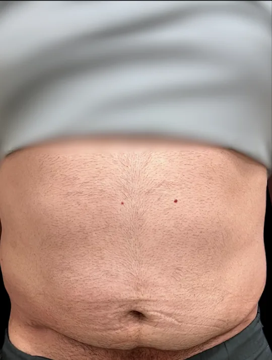 Tummy Tuck, view 3 after