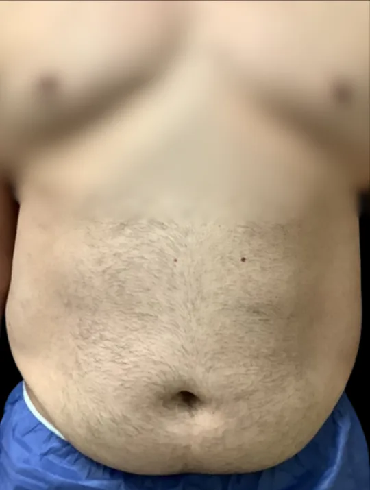 Tummy Tuck, view 3 before