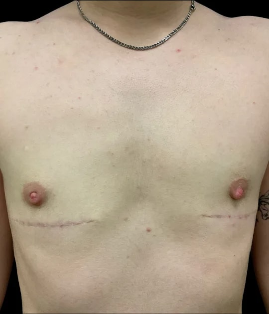Top Surgery, view 2 after