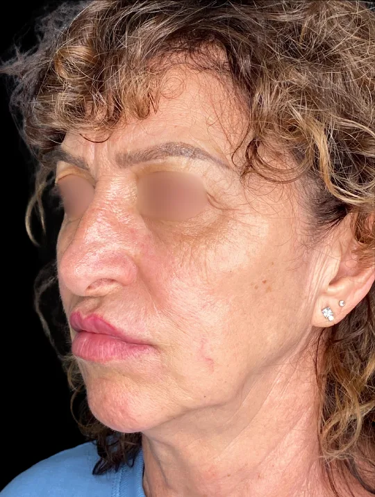 Neck Lift, view 1 before