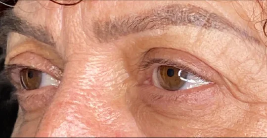 Eyelid Surgery, view 1 before