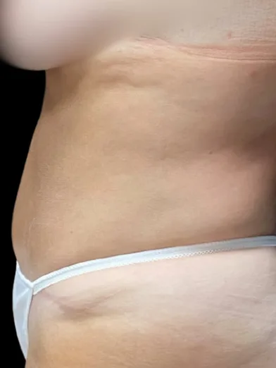 Tummy Tuck, view 1 after