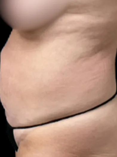 Tummy Tuck, view 1 before