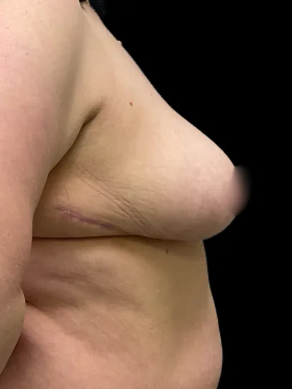 Breast Reduction, view 1 after