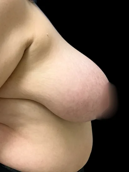 Breast Reduction, view 1 before