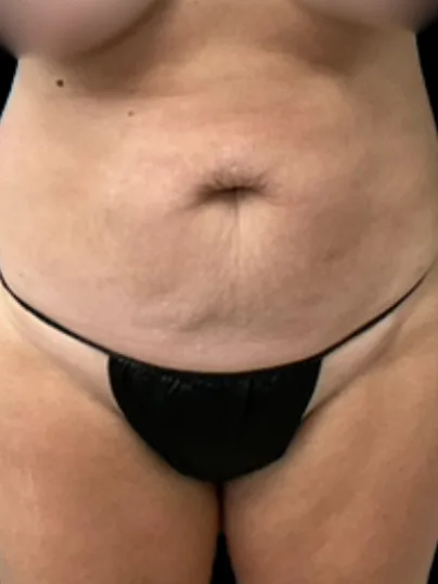 Tummy Tuck, view 1 before