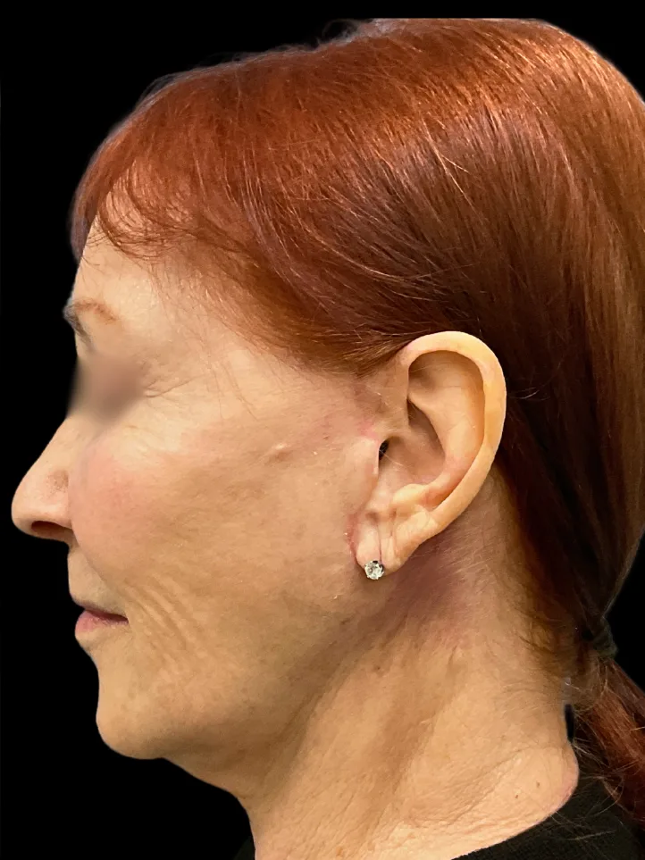 Facelift, view 3 after