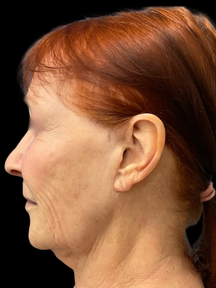 Facelift, view 3 before