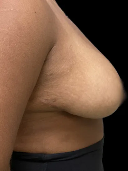 Breast Reduction, view 1 after