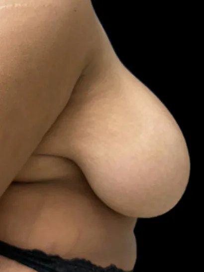 Breast Reduction, view 1 before