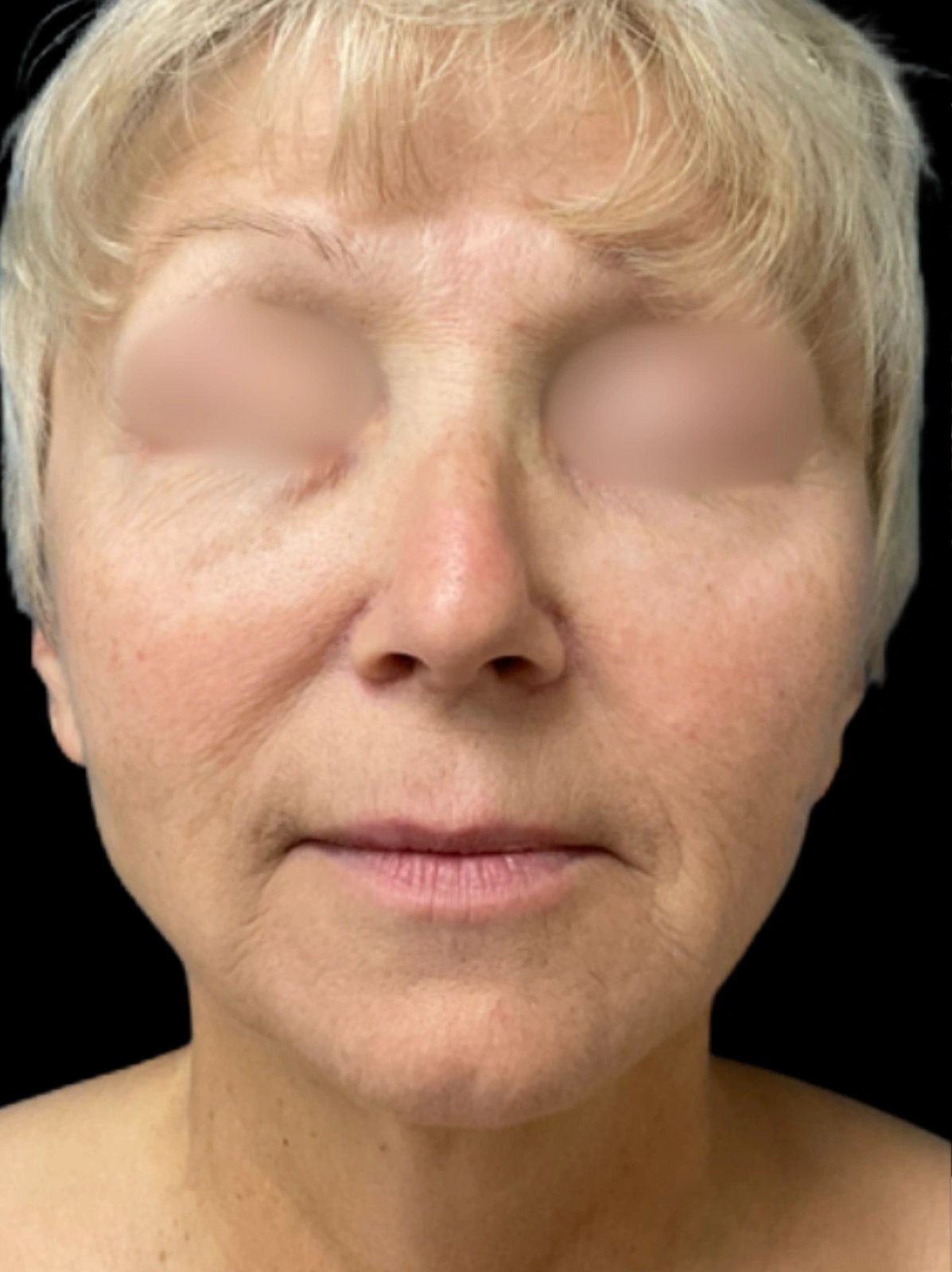 Facelift, view 2 before