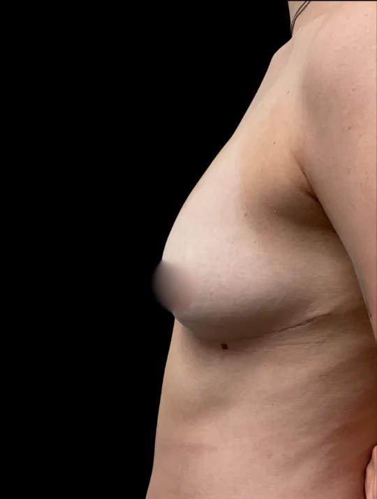 Breast Reduction, view 3 after